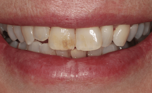 Before